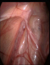 http://www.laserprostata.it/frame/terapie/img/varicocele1.JPG