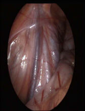 http://www.laserprostata.it/frame/terapie/img/varicocele2.JPG