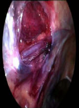 http://www.laserprostata.it/frame/terapie/img/varicocelelaparoscopico.JPG